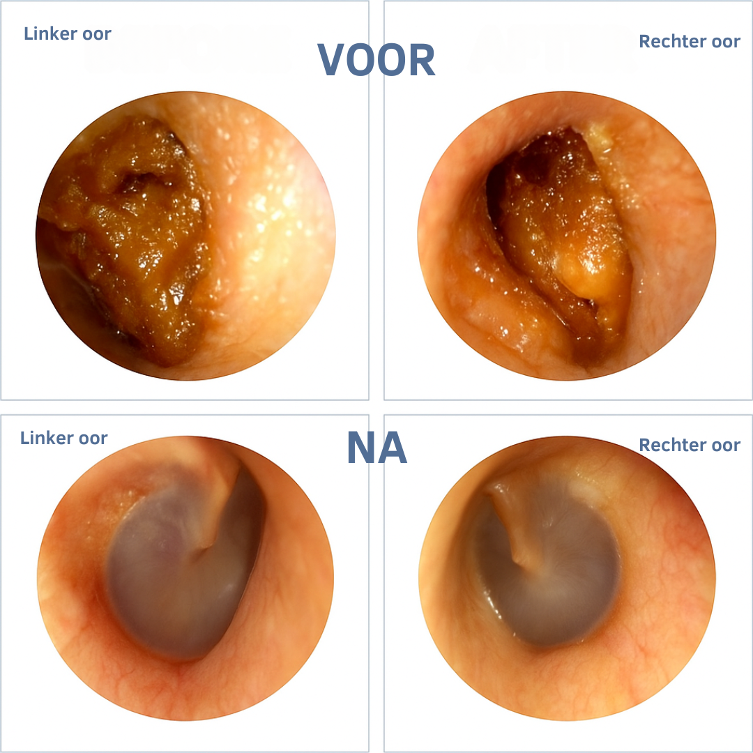 Oorreiniger WAXCLEAN PRO™ | Verwijder Oorsmeer Veilig & Effectief - Nuvando